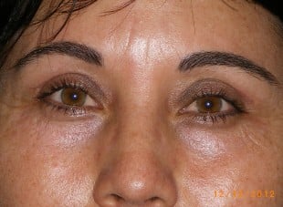 Patient 35 - After View 