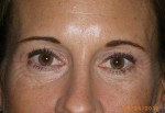 Upper Eyelid Blepharoplasty with Lower Eyelid Laser Resurfacing