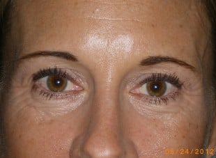 Patient 30 - Before View 