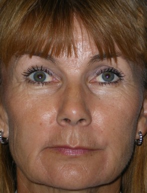 Laser Resurfacing and Fillers