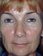 Laser Resurfacing and Fillers