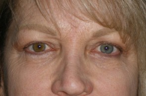 Female Eyelid Surgery