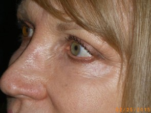 Female Eyelid Surgery