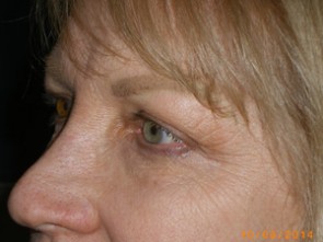 Female Eyelid Surgery