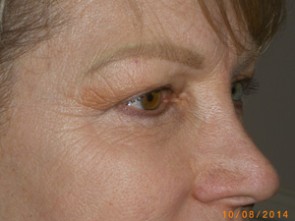 Female Eyelid Surgery