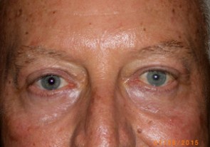 Male Eyelid Surgery