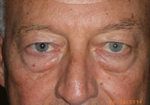 Male Eyelid Surgery