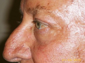 Male Eyelid Surgery