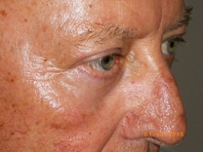 Male Eyelid Surgery