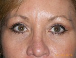 Female Eyelid Surgery