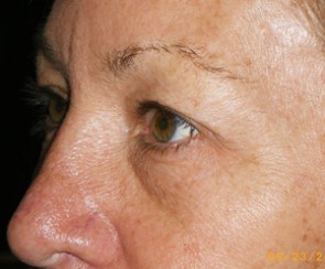 Female Eyelid Surgery