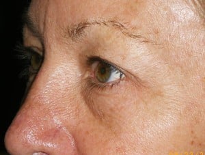 Patient 130 - Before View 