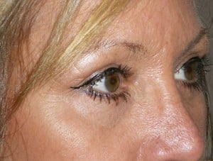 Patient 130 - After View 