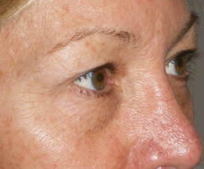 Female Eyelid Surgery