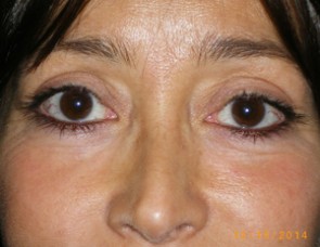 Female Eyelid Surgery