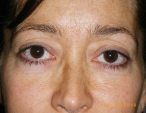 Female Eyelid Surgery
