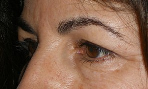 Female Eyelid Surgery