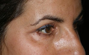 Female Eyelid Surgery