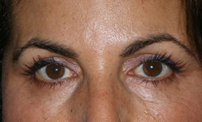 Female Eyelid Surgery