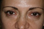 Female Eyelid Surgery