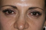 Female Eyelid Surgery