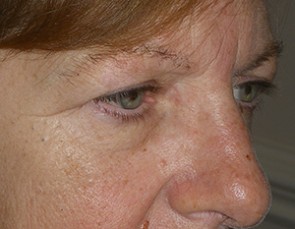 Female Eyelid Surgery