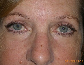 Female Eyelid Surgery