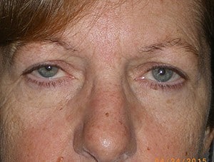 Patient 120 - Before View 