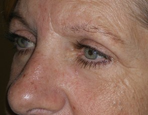 Female Eyelid Surgery