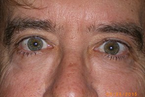 Male Eyelid Surgery