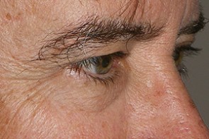 Male Eyelid Surgery