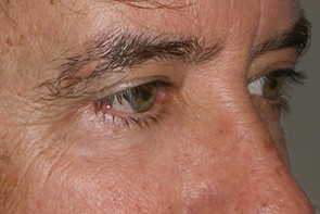 Male Eyelid Surgery