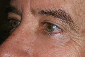 Male Eyelid Surgery