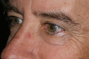 Male Eyelid Surgery