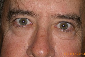 Male Eyelid Surgery