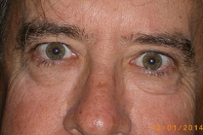 Male Eyelid Surgery