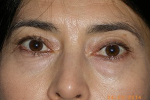 Female Eyelid Surgery