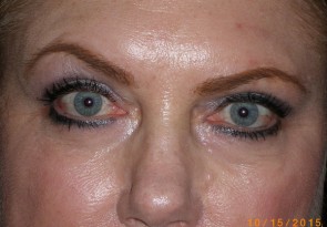 Female Eyelid Surgery