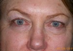 Female Eyelid Surgery