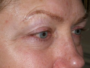 Female Eyelid Surgery