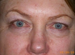 Patient 24 - Before View 
