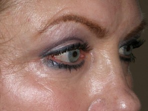 Upper and Lower Eyelid Blepharoplasty with Laser Resurfacing