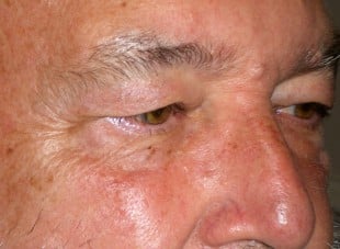 Patient 95 - Before View 