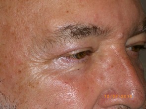 Male Eyelid Surgery