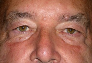 Male Eyelid Surgery