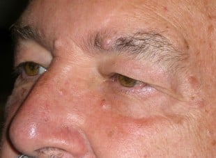Patient 95 - Before View 