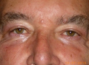Patient 95 - After View 