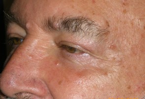 Male Eyelid Surgery