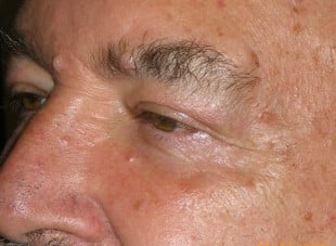 Patient 95 - After View 