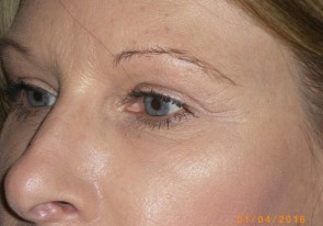 Female Eyelid Surgery